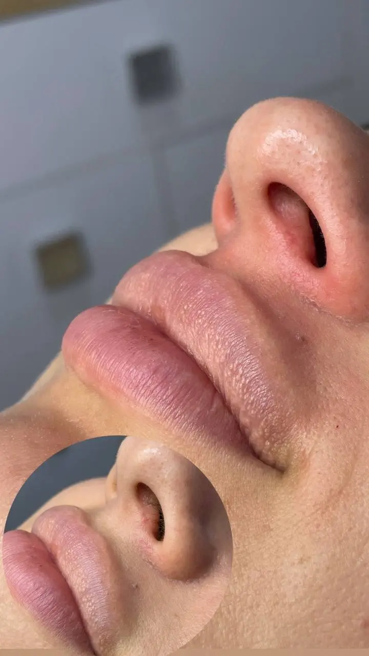 Фото результату депіляції VelvetSkin №12 Професійна воскова депіляція Запоріжжя - результат процедури VelvetSkin №12