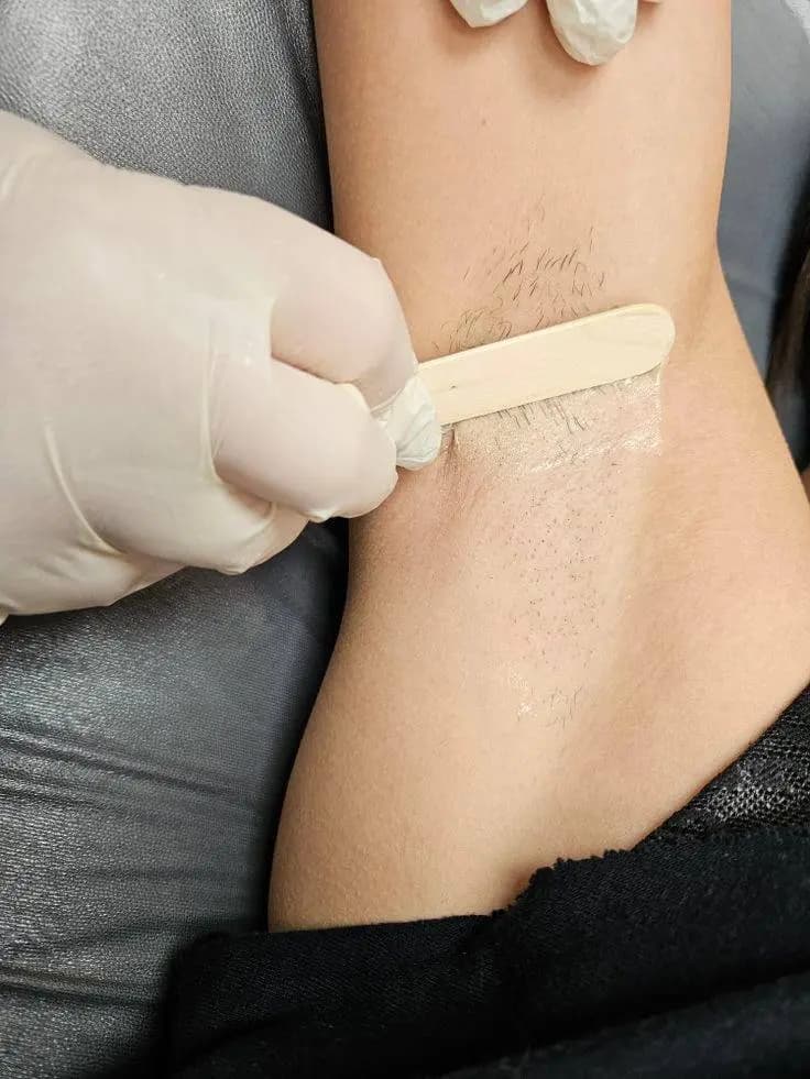 Фото результату депіляції VelvetSkin №4 Професійна воскова депіляція Запоріжжя - результат процедури VelvetSkin №4